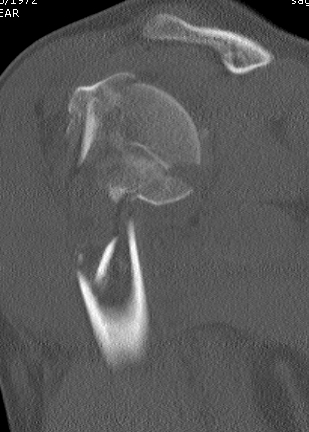 Proximal Humeral Fracture 4 Part Head Splitting CT